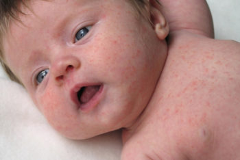 Alergia na pele do bebê: principais causas, sintomas e o que fazer – Tua Saúde