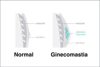 Ginecomastia: o que é, causas e tratamento - Tua Saúde - Viva Com ...