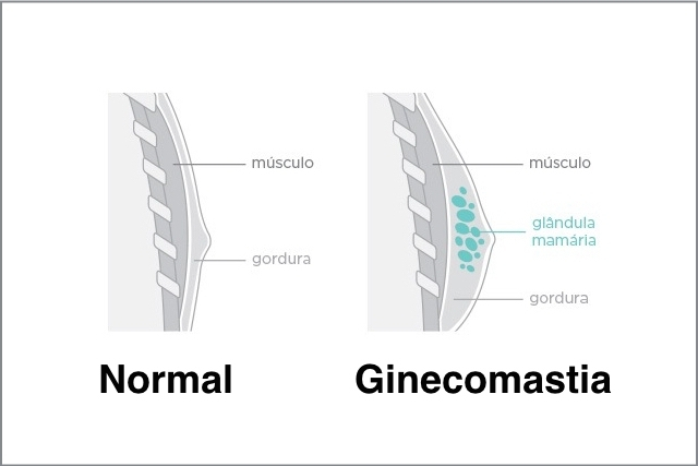 Ginecomastia: o que é, causas e tratamento