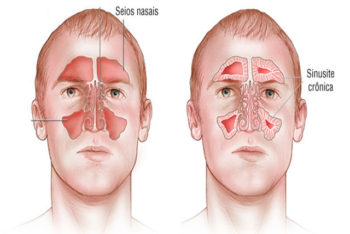 Aprenda como evitar as crises de sinusite de forma natural
