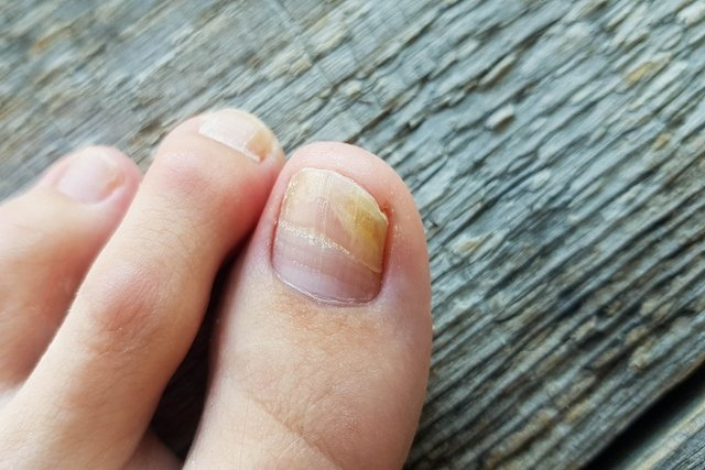 O que pode ser unhas amareladas e o que fazer - Tua Saúde - Viva Com ...