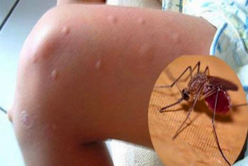 Aprenda as 10 melhores receitas caseiras para aliviar as picadas de mosquitos