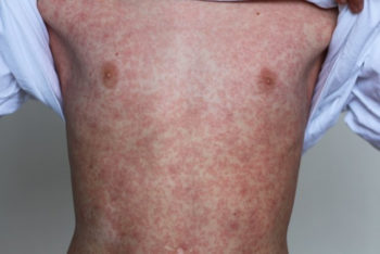 14 doenças que causam manchas vermelhas na pele (com fotos) – Tua Saúde