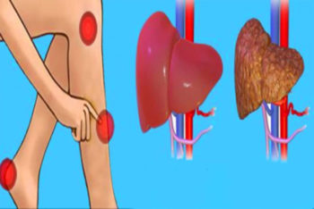 Conheça os sinais de alerta que seu fígado está intoxicado e que você vai ganhar peso