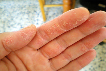 Aprenda a acabar com eczemas usando o vinagre