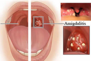 Conheça os chás naturais para aliviar dor de garganta e amigdalite em até 4 horas