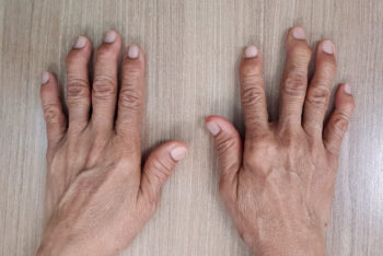 Artrite reumatóide: o que é, sintomas, causas e tratamento – Tua Saúde