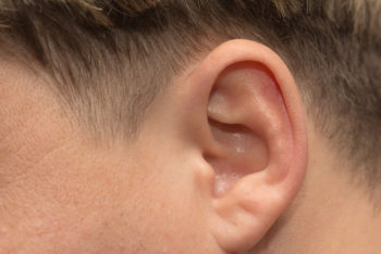 Queloide na orelha: como é feito o tratamento, causas e como evitar – Tua Saúde