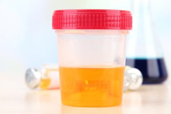 Urobilinogênio na urina: o que pode ser e o que fazer – Tua Saúde