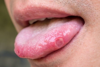 Afta na língua: sintomas, causas e tratamento – Tua Saúde