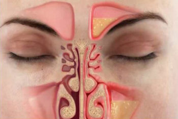 Aprenda a eliminar a congestão nasal em menos de um minuto